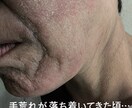 くり返す肌荒れ経験者がその苦しさ受けとめます ずっとくり返す、なんで私だけ? もうイヤ!! イメージ2