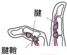 簡単な指体操だけで治る”ばね指”の治療法を教えます えッこんな簡単な指体操で！　即効性にきっと歓喜するでしょう。 イメージ3