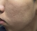 実際の経験をもとにアドバイスします 一緒にニキビの原因を分析していきましょう！ イメージ3