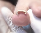 この爪どうやって切ったらいいの？その疑問に答えます 爪のトラブルお任せください！！ イメージ3