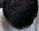 薄毛の方に朗報。私が改善した体験談をお伝えします 男性専用となります。特に頭頂部が薄い方はご相談下さい。 イメージ9