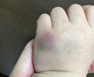 血小板減少性紫斑病になったら…お教えします 血小板減少性紫斑病ってなに？不安なご両親様へ イメージ1