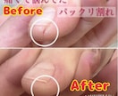 パックリ、ヒビ割れの治す方法をお教えします ひび、パックリ割れ痛いですよね。しっかり根完治しましょう。 イメージ3