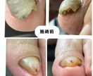 巻き爪様子がおかしい爪　足の相談お受けします 病院はコワい気になる足の事写真を送るだけで改善したい！ イメージ4
