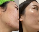 ノーファンデ肌になるための方法をお伝えします 何をしても治らなかった肌トラブル向け イメージ4