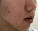 実際の経験をもとにアドバイスします 一緒にニキビの原因を分析していきましょう！ イメージ2