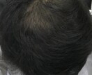 薄毛の方に朗報。私が改善した体験談をお伝えします 男性専用となります。特に頭頂部が薄い方はご相談下さい。 イメージ4