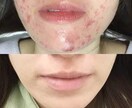 治らないニキビ！落ち着く方法教えます 合わない方もいるので確実とは言えません イメージ1