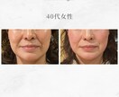 顔に鍼を打ってるだけ”から卒業できます お客様に変化を実感させる美容鍼の基礎からの打ち方 イメージ6