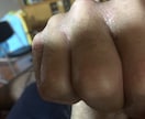 アトピーの話し聞きますます アトピー経験者がアトピーになった人しか分からない思いを聞く イメージ6