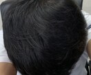 薄毛の方に朗報。私が改善した体験談をお伝えします 男性専用となります。特に頭頂部が薄い方はご相談下さい。 イメージ10