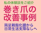 巻き爪でお困りの方へ、わたしの対処法を紹介します 以前は両足の親指が化膿していましたが今は好転しかなり歩けます イメージ1