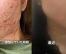 皮膚科で治らないニキビを改善した方法をお伝えします 生活習慣を見直して、ニキビができにくい肌を目指しませんか？ イメージ1