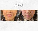 顔に鍼を打ってるだけ”から卒業できます お客様に変化を実感させる美容鍼の基礎からの打ち方 イメージ2