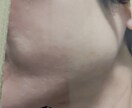 くり返す肌荒れ経験者がその苦しさ受けとめます ずっとくり返す、なんで私だけ? もうイヤ!! イメージ3
