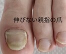 巻き爪様子がおかしい爪　足の相談お受けします 病院はコワい気になる足の事写真を送るだけで改善したい！ イメージ5