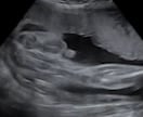 赤ちゃんのエコー動画から性別判定します 10〜13週ベビーナブ判定、それ以降は外性器による判定 イメージ4
