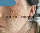 アトピーや敏感肌でお悩みの方、お話聞きます 食事、スキンケア、生活についてのお悩みなんでも イメージ2