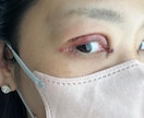 眼瞼下垂（二重整形）手術後の合併症　後遺症相談ます 2年半の生活変化と私の乗り越え方 イメージ1