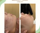 先着15名★肌改善のプロがニキビ肌を美肌へ導きます 15年ニキビに悩んだプロが教える！お金をかけない美肌ケア イメージ5