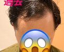 薄毛でお悩みの方。格安！私の成功法お教えします 若禿の私が実際に行い成功した、格安な方法お教えします！ イメージ3