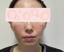 赤ら顔、脂漏性湿疹の経験の改善点お伝えします 気をつけたことや具体的なスキンケア製品等をお伝えします。 イメージ2