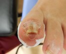 写真でわかる巻き爪診断｜巻き爪専門がチェックします 今の状態が良いのか治療を必要とするのか具体的に説明致します。 イメージ9