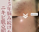 先着15名★肌改善のプロがニキビ肌を美肌へ導きます 15年ニキビに悩んだプロが教える！お金をかけない美肌ケア イメージ2