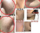 美肌へ肌悩みのカウンセリング➕肌改善方法教えます プロ資格講師自宅ケア改善指導ニキビ肌荒れ改善法伝授 イメージ2