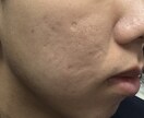 実際の経験をもとにアドバイスします 一緒にニキビの原因を分析していきましょう！ イメージ4