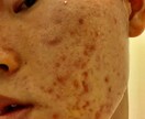 ニキビについて悩んでいる方、心の医者になります 。皮膚科の先生には分からない悩みに最後まで寄り添います。 イメージ1