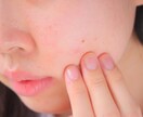 アトピー相談受けます 私流のアトピーとの付き合い方伝授します！ イメージ2
