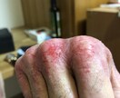 アトピーの話し聞きますます アトピー経験者がアトピーになった人しか分からない思いを聞く イメージ5