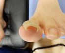 写真でわかる巻き爪診断｜巻き爪専門がチェックします 今の状態が良いのか治療を必要とするのか具体的に説明致します。 イメージ4