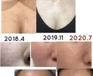 美肌へ肌悩みのカウンセリング➕肌改善方法教えます プロ資格講師自宅ケア改善指導ニキビ肌荒れ改善法伝授 イメージ5