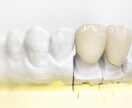 歯の詰め物や入れ歯を入れる前にご相談乗ります 保険〜高級な詰め物、入歯まで先生の説明に納得されてますか？ イメージ1