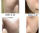 美肌へ肌悩みのカウンセリング➕肌改善方法教えます プロ資格講師自宅ケア改善指導ニキビ肌荒れ改善法伝授 イメージ1