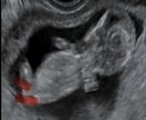 赤ちゃんのエコー動画から性別判定します 10〜13週ベビーナブ判定、それ以降は外性器による判定 イメージ2