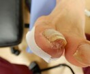 写真でわかる巻き爪診断｜巻き爪専門がチェックします 今の状態が良いのか治療を必要とするのか具体的に説明致します。 イメージ7