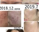 美肌へ肌悩みのカウンセリング➕肌改善方法教えます プロ資格講師自宅ケア改善指導ニキビ肌荒れ改善法伝授 イメージ6