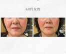 顔に鍼を打ってるだけ”から卒業できます お客様に変化を実感させる美容鍼の基礎からの打ち方 イメージ5