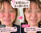 赤ら顔で悩むあなたのお話を聞きます 7年間悩んだ私が実体験をもとに寄り添います イメージ2