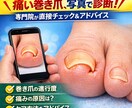 写真でわかる巻き爪診断｜巻き爪専門がチェックします 今の状態が良いのか治療を必要とするのか具体的に説明致します。 イメージ1