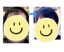 発毛経験、プロペシアの使用体験教えます 薄毛に悩んでプロペシアの使用を考えたことはありませんか？ イメージ1