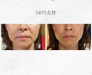 顔に鍼を打ってるだけ”から卒業できます お客様に変化を実感させる美容鍼の基礎からの打ち方 イメージ4