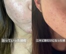 皮膚科で治らないニキビを改善した方法をお伝えします 生活習慣を見直して、ニキビができにくい肌を目指しませんか？ イメージ2