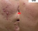 ノーファンデ肌になるための方法をお伝えします 何をしても治らなかった肌トラブル向け イメージ1