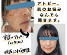 誰にも話せないアトピーの悩み聞きます経験談話します 20年間アトピーに悩み脱ステロイドを経験し、改善したOLです イメージ1