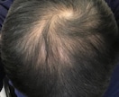 薄毛の方に朗報。私が改善した体験談をお伝えします 男性専用となります。特に頭頂部が薄い方はご相談下さい。 イメージ2