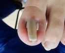 写真でわかる巻き爪診断｜巻き爪専門がチェックします 今の状態が良いのか治療を必要とするのか具体的に説明致します。 イメージ8
